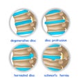 Spine diseases. Various pathologies of intervertebral discs and bones.